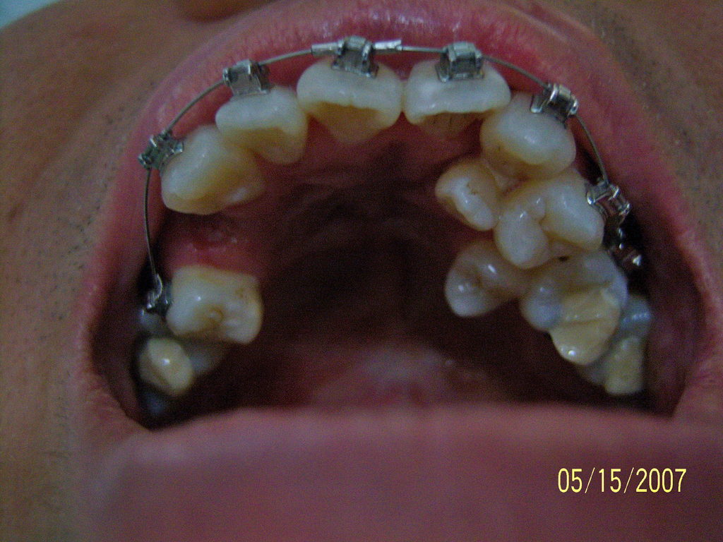 Upper row after extraction 1 - 