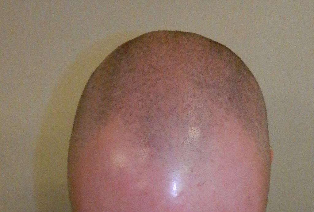 arashiAftershavePreop - 