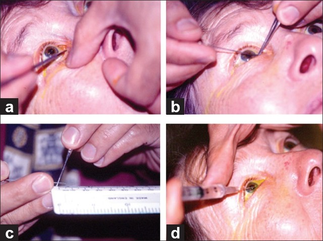 MiddleEastAfrJOphthalmol 2012 19 1 60 92117 f6 à¸ºà¸ºBloggang