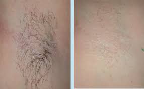 2 City Hair Removal