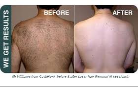 4 City Hair Removal