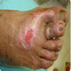 diabetic foot care - Best Vascular Surgeon Delhi