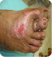 diabetic foot care Best Vascular Surgeon Delhi