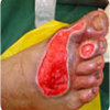 diabetic foot care center - Best Vascular Surgeon Delhi