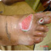 diabetic foot treatment - Best Vascular Surgeon Delhi