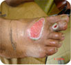 diabetic foot treatment Best Vascular Surgeon Delhi