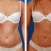 liposuction beverly hills - Picture Box