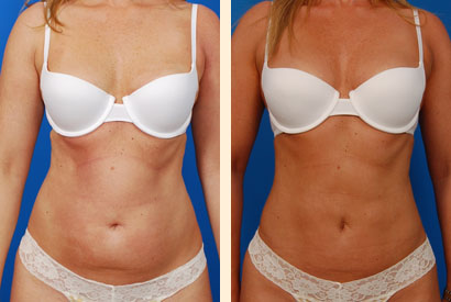 liposuction beverly hills Picture Box