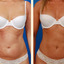 breast augmentation beverly... - Picture Box