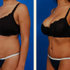 liposuction beverly hills - Picture Box