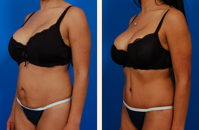 liposuction beverly hills Picture Box