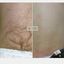 Laser Hair Removal - Picture Box