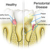periodontitis1 - Oral Health