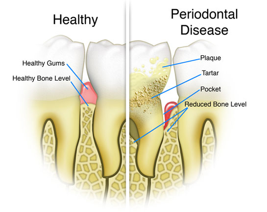 periodontitis1 Oral Health