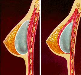 Breast Implant Surgeons in Las Vegas Breast Augmentation Las Vegas  
