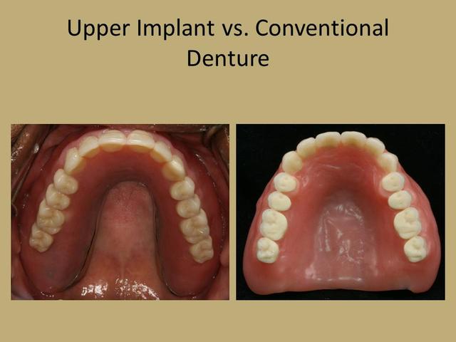 upper dental1 Picture Box