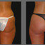 chicago lipo center - Chicago Lipo Center