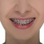 invisalign teen - Picture Box