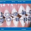 invisalign teen - Picture Box