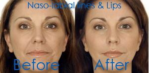 Anti Wrinkle Injections Sydney			 Star Cosmetic Medicine