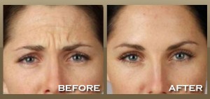 Dermal Fillers Sydney  Star Cosmetic Medicine