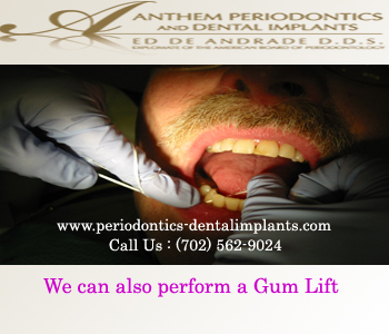 Dental Implants Henderson Dental Implants Henderson