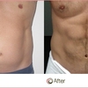 Liposuction - Cosmos Clinic