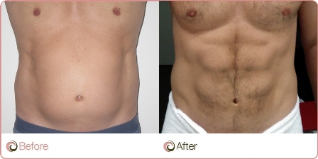 Liposuction Cosmos Clinic