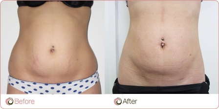 Liposuction Cosmos Clinic