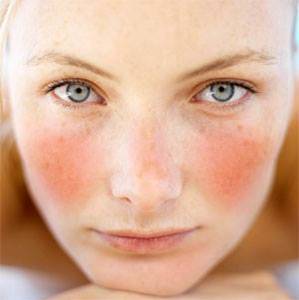 IMAGEN ROSACEA - Anonymous