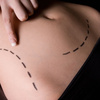 liposuction sacramento