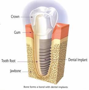 Dental Implants Delhi Dentist Delhi