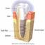 Dental Implants Delhi - Dentist Delhi