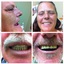 dentures peterborough - Apple Denture and Implant Solutions