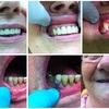 dentures toronto - Apple Denture and Implant S...