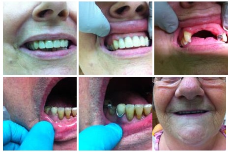dentures toronto Apple Denture and Implant Solutions
