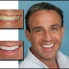 Veneers Atlanta