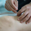 electroacupuncture - Alban Acupuncture & Herbs Clinic