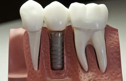 Zobni Implantat Jubljana od Artident Artident