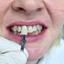 Zobni vsadki od Artident - Artident