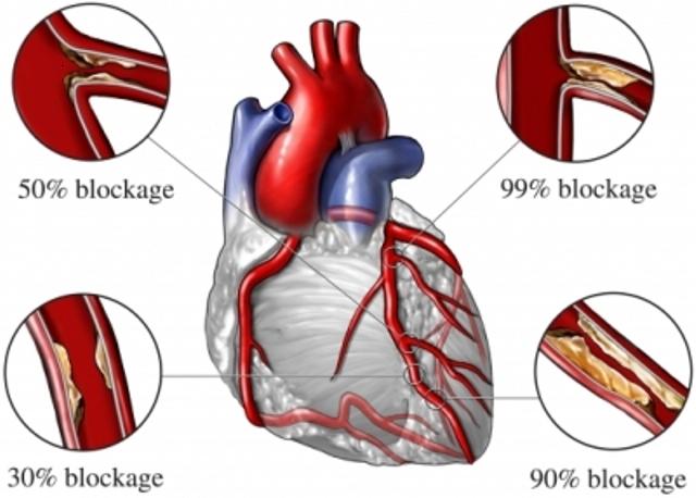 High Triglycerides Picture Box