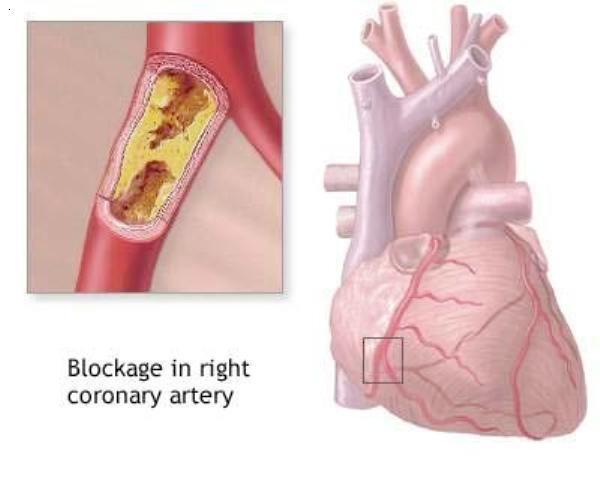 high triglycerides2 Picture Box
