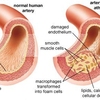 High triglycerides3 - Picture Box