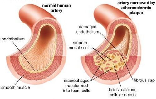 High triglycerides3 Picture Box