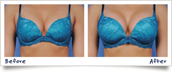 actual-patient-before-after-silicone-breast-implan http://www.1285facts.com/naturaful-breast-cream-review/
