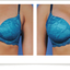 actual-patient-before-after... - http://www.1285facts.com/naturaful-breast-cream-review/