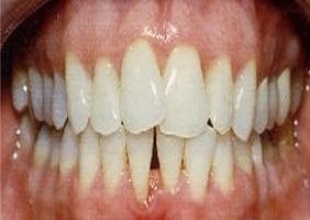 gingival graft raleigh nc Spectrum Family Dentistry