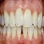 gingival graft raleigh nc - Spectrum Family Dentistry