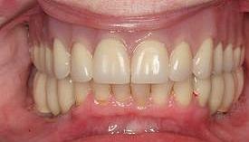 Implant dentistry raleigh nc Spectrum Family Dentistry