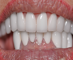 Implant dentistry raleigh nc Spectrum Family Dentistry